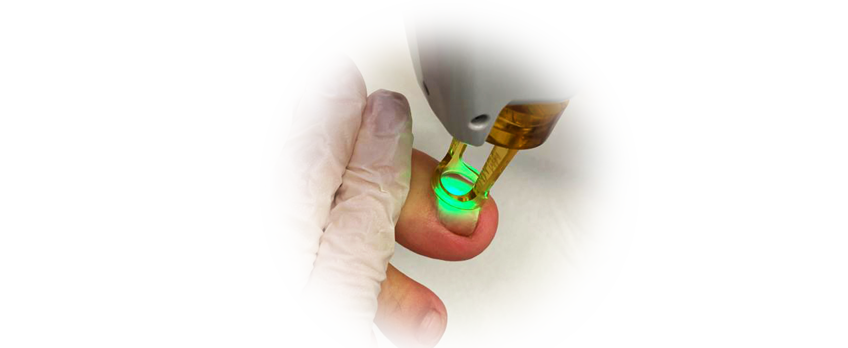 onykos - tratamentos onicomicoses