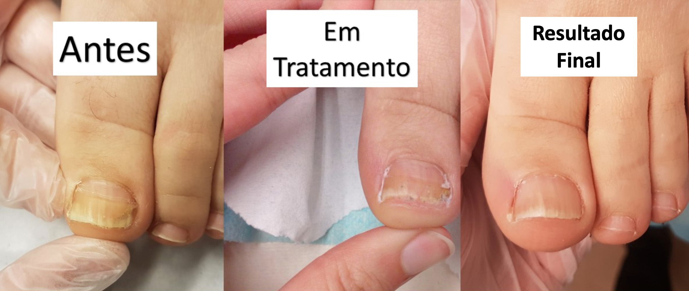 onicomicose tratamento exemplo